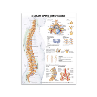 Póster de enfermedades de la columna vertebral en inglés