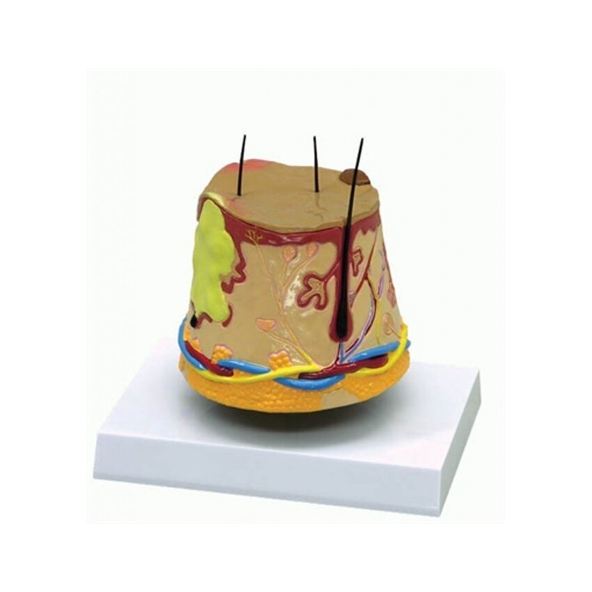 modelo de acné
