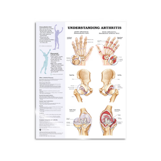 Artritis laminada en inglés