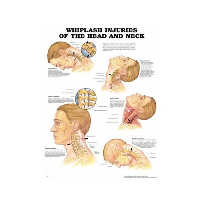 Póster laminado sobre lesiones por latigazo cervical (en inglés)