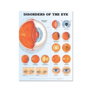 Póster laminado sobre enfermedades oculares (trastornos oculares)