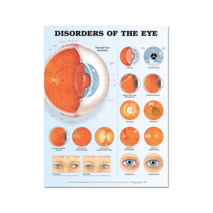 Póster laminado sobre enfermedades oculares (trastornos oculares)