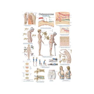Póster sobre osteoporosis, póster anatómico de 50x70 cm.