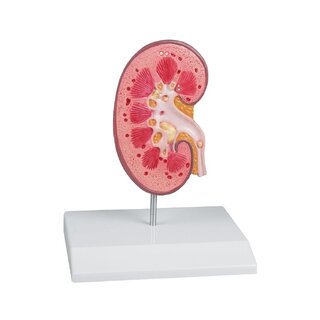 modelo de cálculo renal