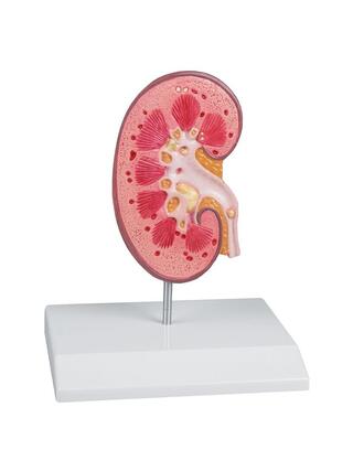 modelo de cálculo renal