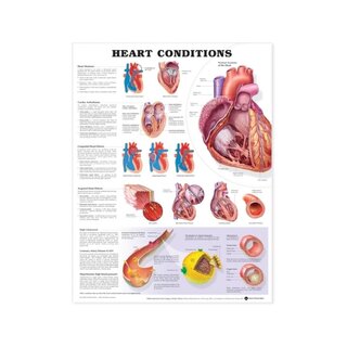 Póster laminado sobre enfermedades cardíacas (afecciones cardíacas)