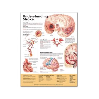 Comprensión del accidente cerebrovascular (Entendiendo el accidente cerebrovascular)