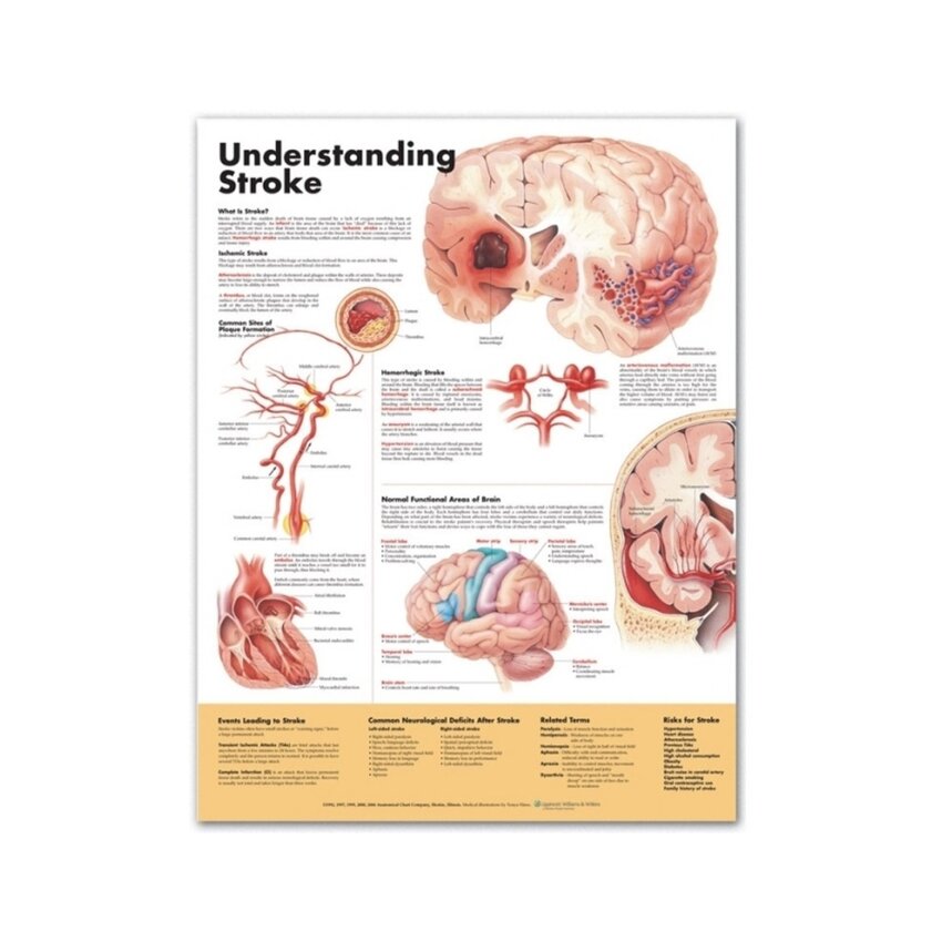Comprensión del accidente cerebrovascular (Entendiendo el accidente cerebrovascular)