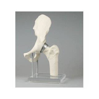 Modelo de articulación de cadera con implante - Birmingham Hip