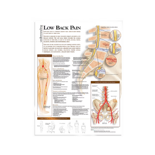 Póster laminado sobre dolor lumbar en inglés