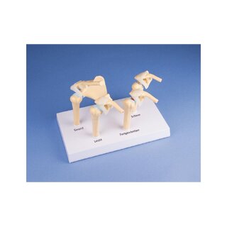 Modelo de osteoartritis (OA) de hombro en 4 etapas