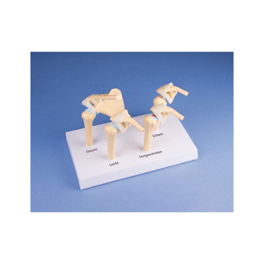Modelo de osteoartritis (OA) de hombro en 4 etapas