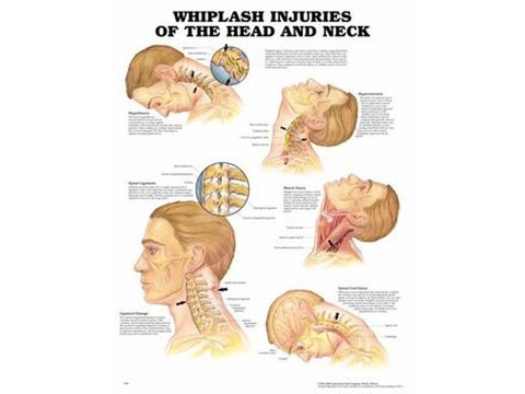 Carteles sobre enfermedades musculoesqueléticas