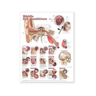 Póster laminado sobre enfermedades del oído medio en inglés